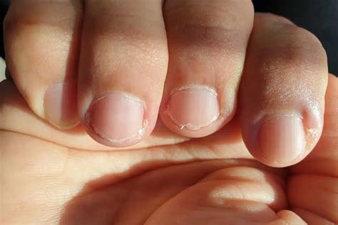 Common Nail Problems and How to Solve them in St Clair Shores
